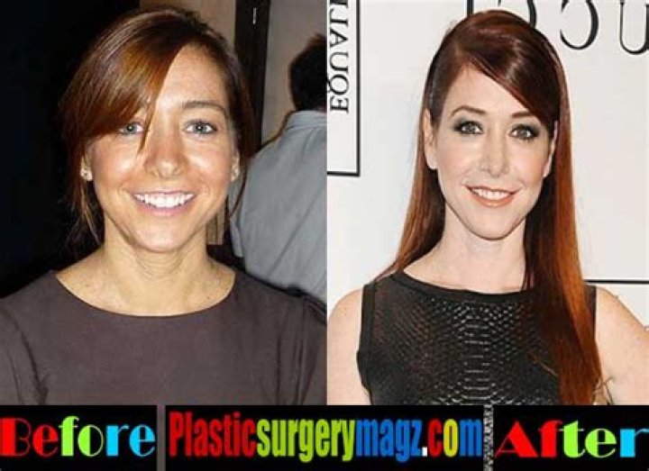 Alyson Hannigan Plastic Surgery Before and After