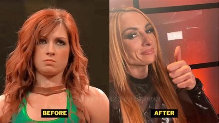 Becky Lynch Plastic Surgery: Becky Came Clear Over the Fans' Speculations!