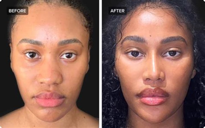 Jay-Z Nose Job Plastic Surgery Before and After