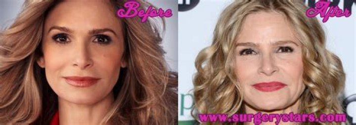 Kyra Sedgwick Plastic Surgery Before and After