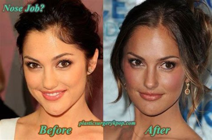 Minka Kelly Plastic Surgery Before and After