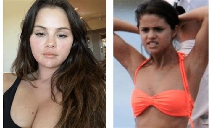 Selena Gomez Breast Implants Plastic Surgery Before and After