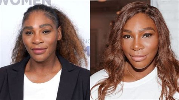 Serena Williams Plastic Surgery: Nose Job, Breast Implants, or Skin Whitening Treatment?