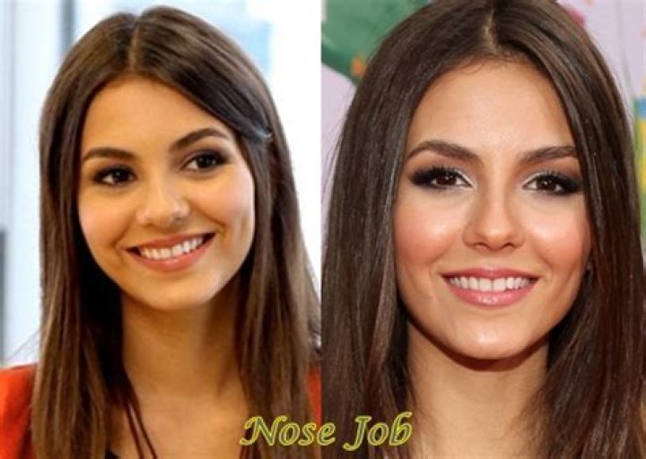 Victoria Justice Plastic Surgery Before and After